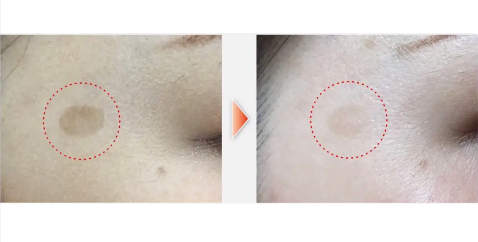 SPOTCLEAR | Mole + Freckle Removal System