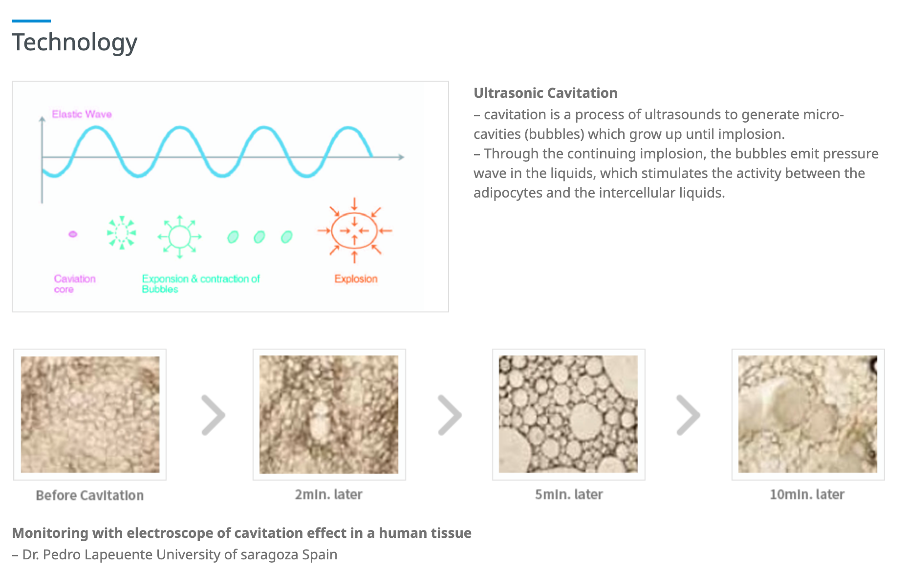 Ultrasonic Cavitation, Frequently Asked Question